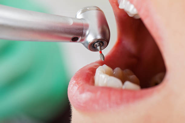 Best Dentist for Tooth Abscess  in Cape St Claire, MD